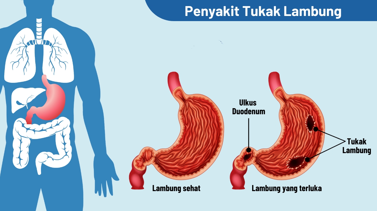 Gambar artikel TUKAK LAMBUNG