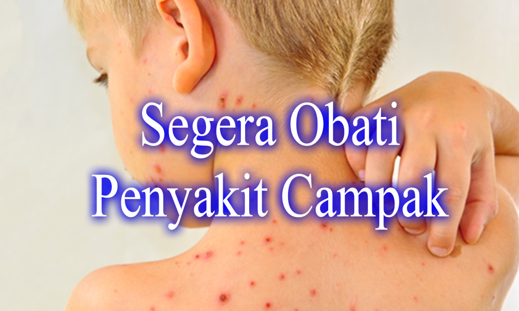 Gambar artikel apa itu CAMPAK?